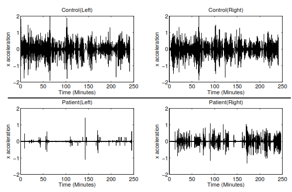 Publication thumbnail for A Pilot Study on the Use of Accelerometer Sensors for Monitoring Post Acute Stroke Patients