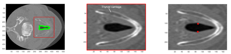 Publication thumbnail for Arytenoid Cartilage Feature Point Detection Using Laryngeal 3D CT Images in Parkinson's Disease